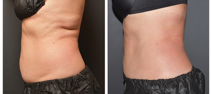 Coolsculpting Treatment Nj Freeze Your Fat Slate Medspa