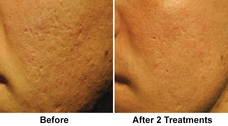 acne-male-2-treatments
