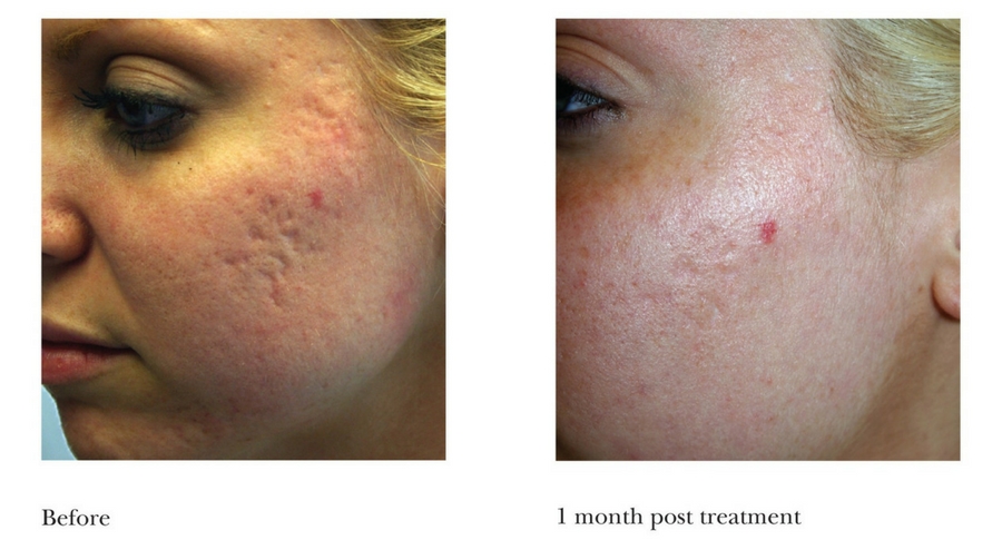 acne-scarring-3 acne-scarring-3