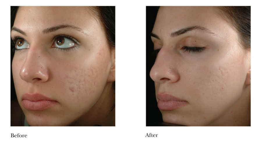 acne-scarring-4 acne-scarring-4