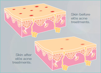 acne-treatment acne-treatment