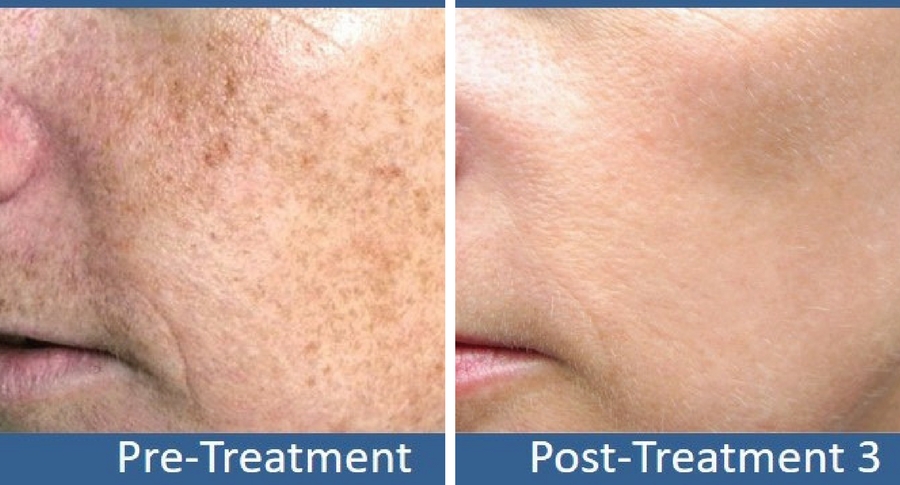 ipl-photofacial-10 ipl-photofacial-10