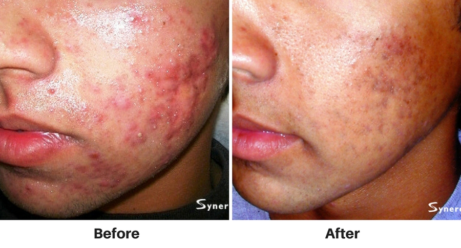 nuimage-acnetreatment2 nuimage-acnetreatment2
