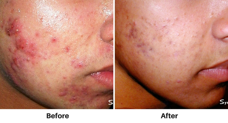 nuimage-acnetreatment3 nuimage-acnetreatment3