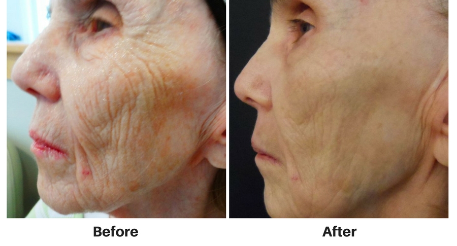 Nuimage Before And After Microneedling2 Slate Medspa