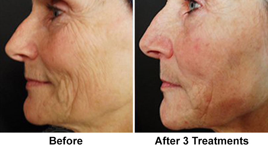 wrinkles-micro-3-treatments