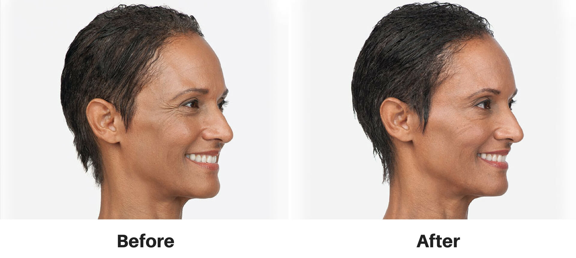 botoxnj2 Slate Medspa