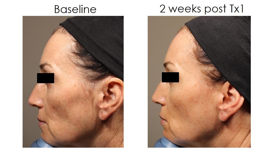 ipl-photofacial-1 ipl-photofacial-1