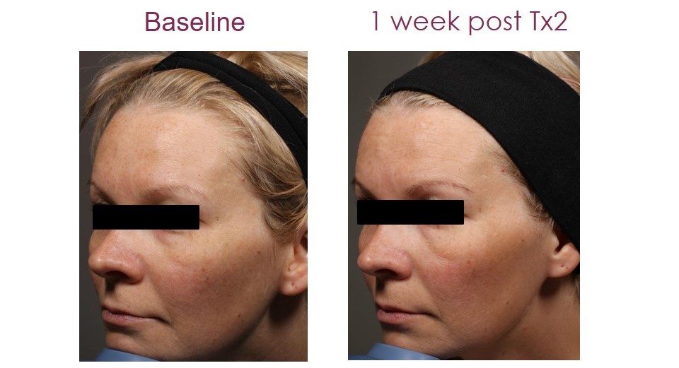 ipl-photofacial-2 ipl-photofacial-2