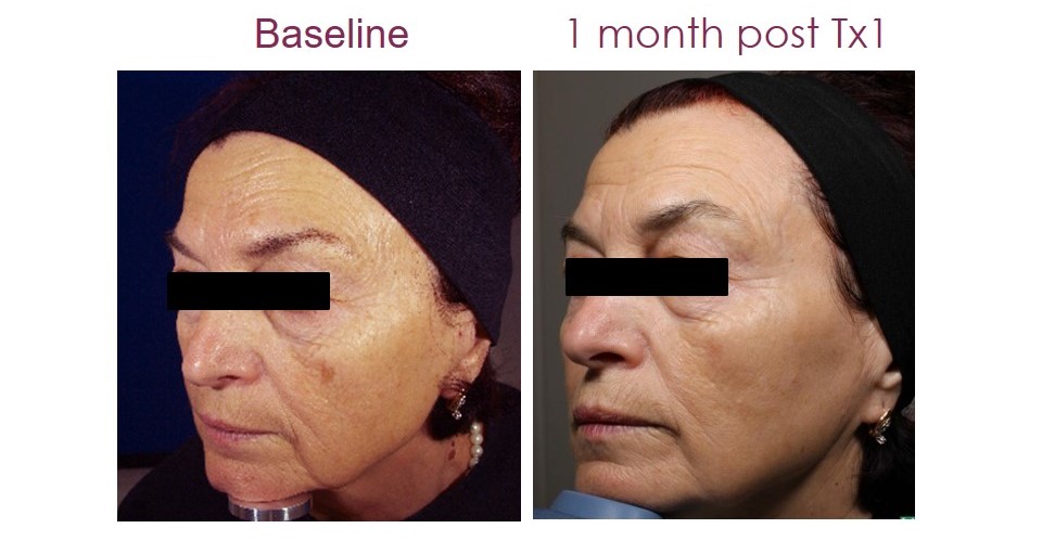 ipl-photofacial-4 ipl-photofacial-4