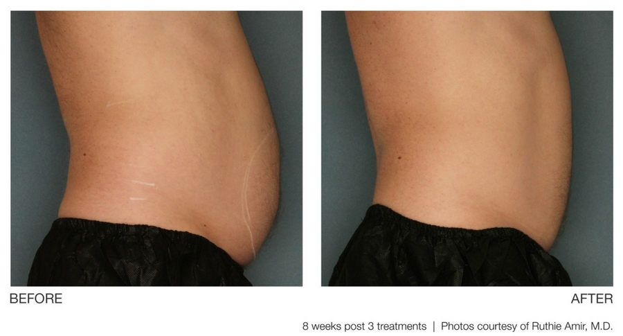 ultrashape-1 ultrashape-1