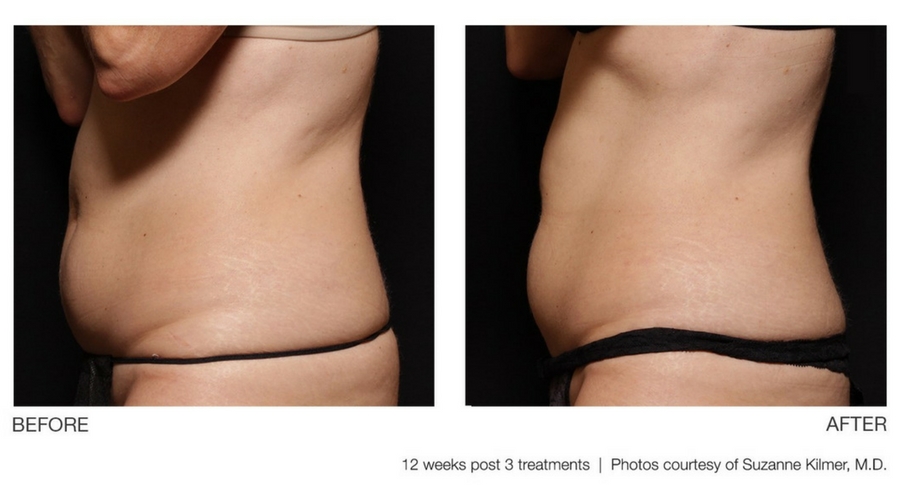 ultrashape-5 ultrashape-5