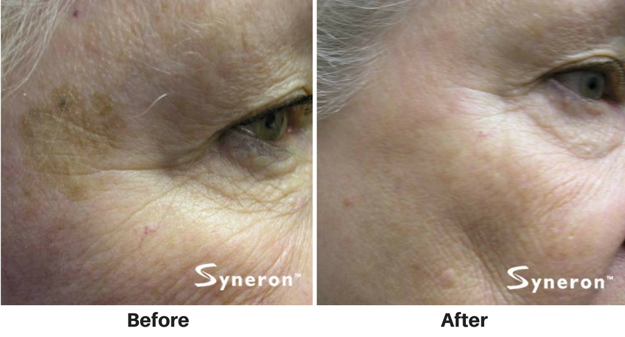 ipl-photofacial-6 ipl-photofacial-6