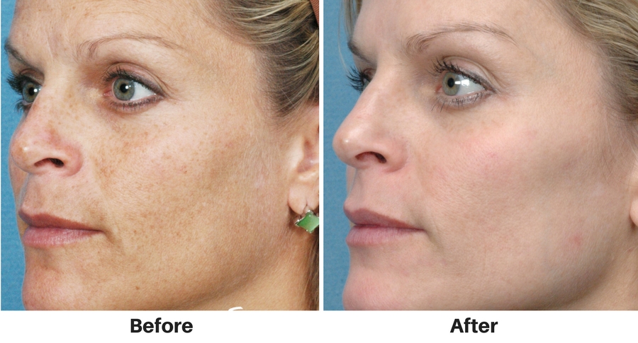 ipl-photofacial-7 ipl-photofacial-7