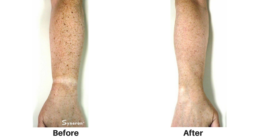 ipl-photofacial-8 ipl-photofacial-8