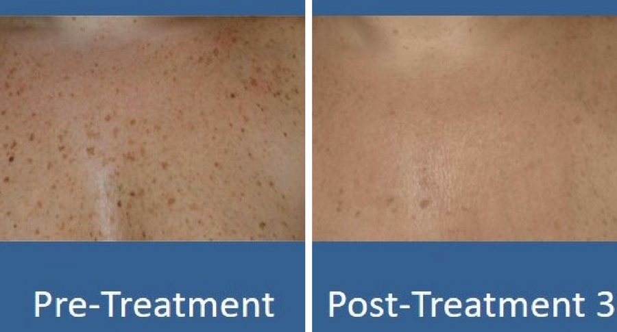 ipl-photofacial-9 ipl-photofacial-9