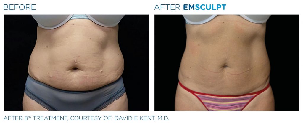 nuimage-emsculpt-before-and-after-1