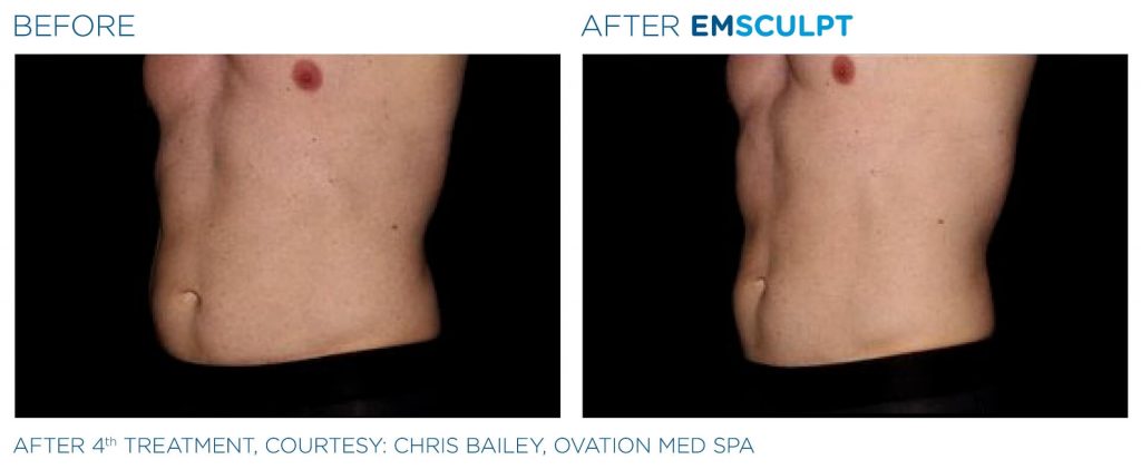 nuimage-emsculpt-before-and-after-2