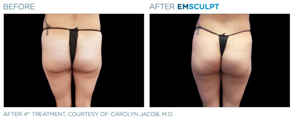 nuimage-emsculpt-before-and-after-3