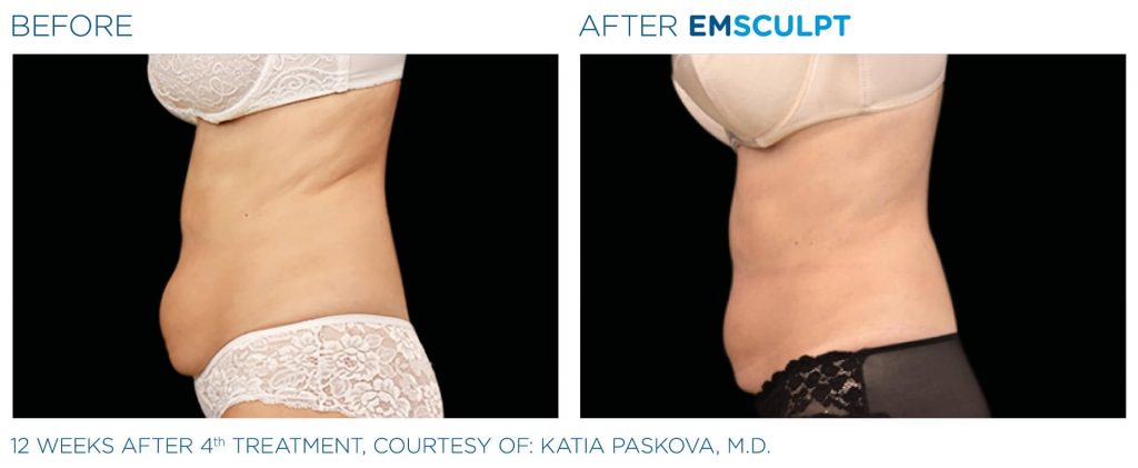 nuimage-emsculpt-before-and-after-4