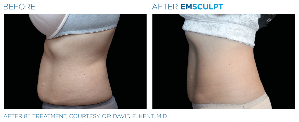 Before & After: Result of EMSculpt treatment in Paris