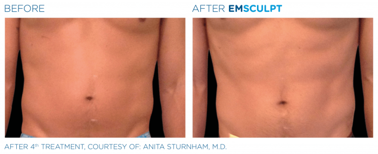 Emsculpt Before And After Pictures Show Real Results - Slate Medspa