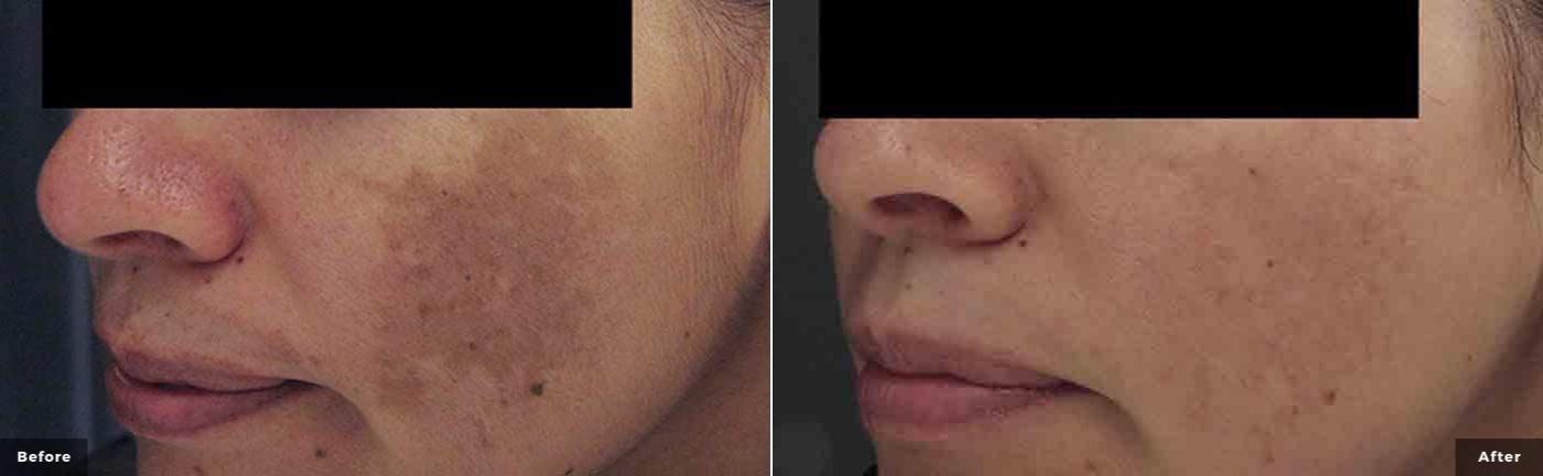 laser_genesis_facial_before_and_after_1