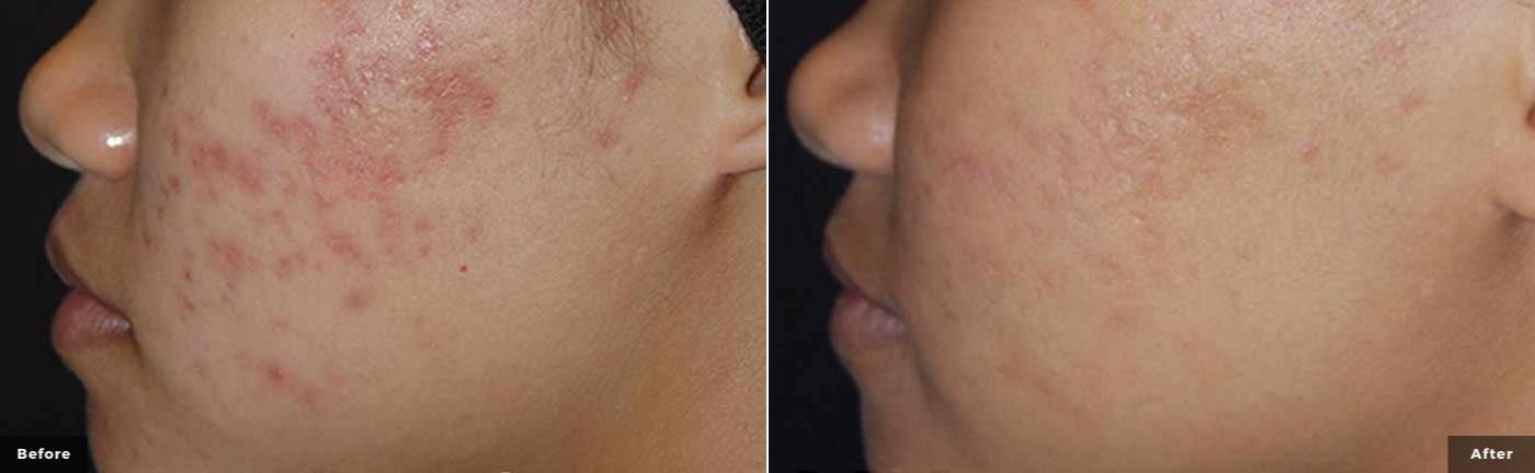 laser_genesis_facial_before_and_after_2