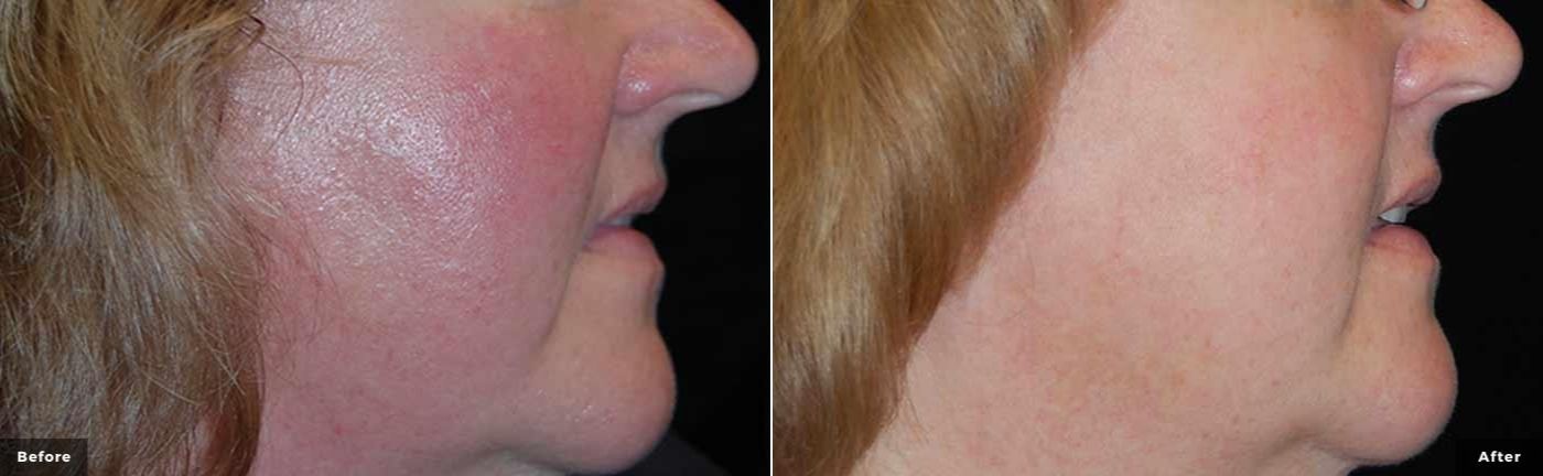 laser_genesis_facial_before_and_after_3