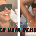 painless laser hair removal from slate medspa