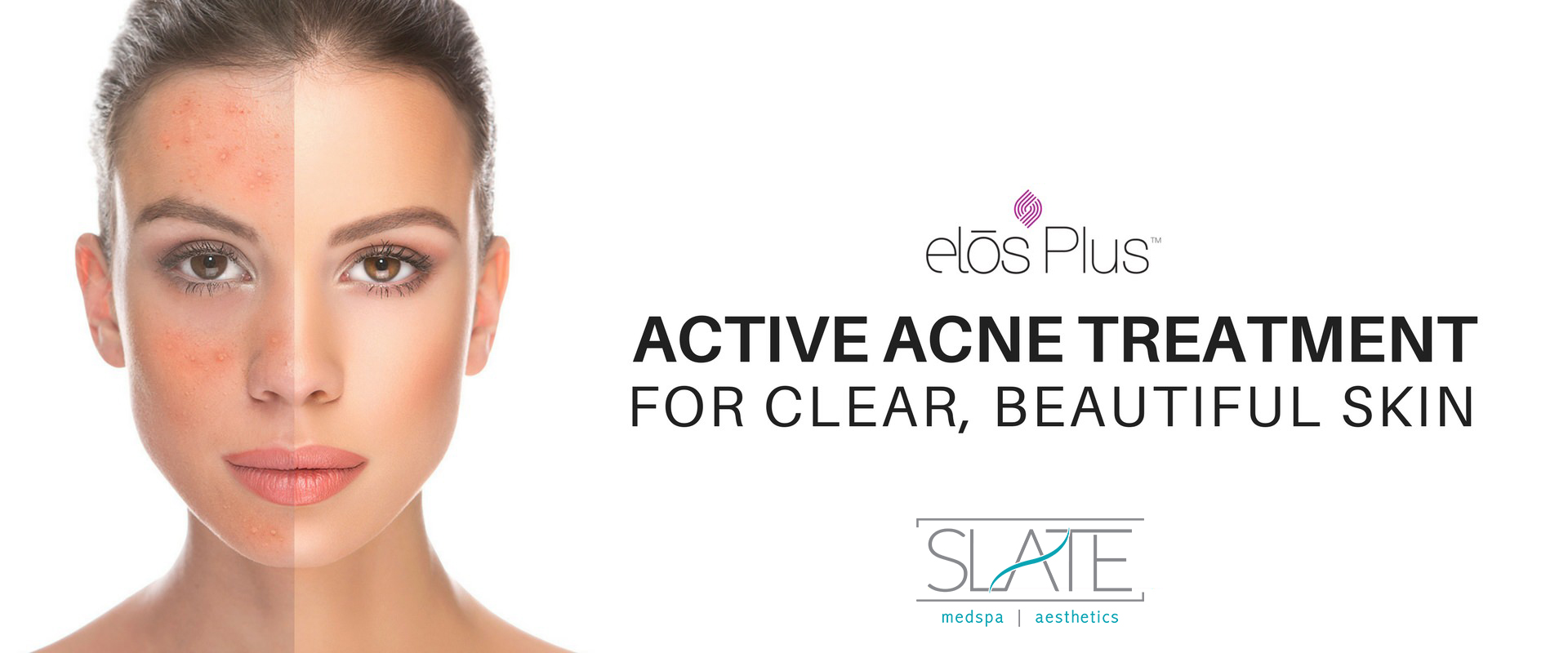 acne-treatment.slate-medspa acne-treatment.slate-medspa