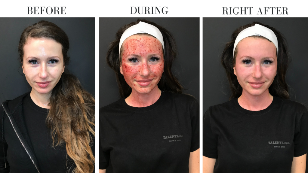 Radiofrequency Microneedling: Before and After Photos