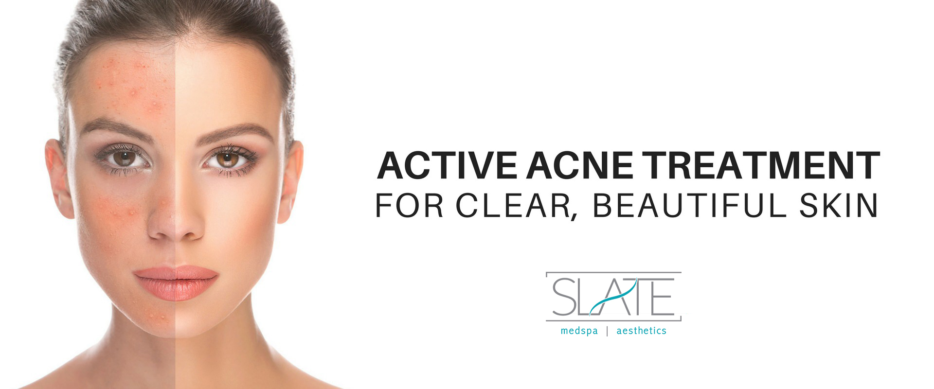 acne-treatment.slate-medspa