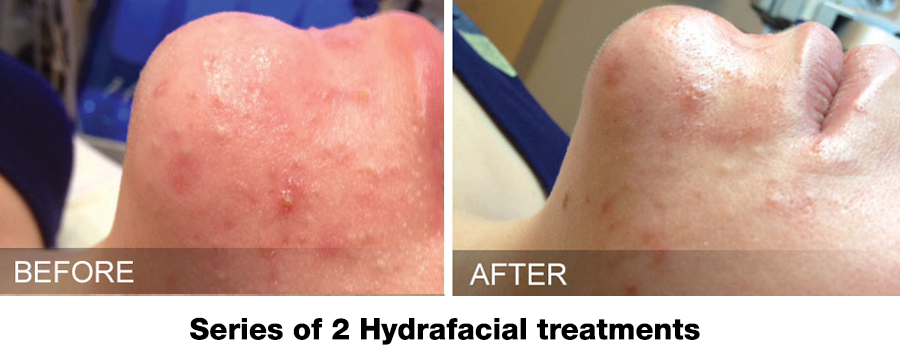 ba-active-acne-hydrafacial ba-active-acne-hydrafacial