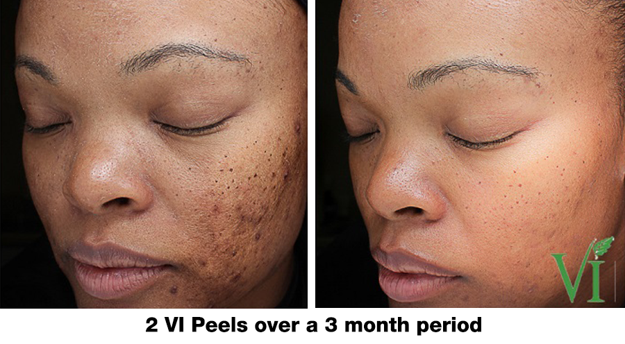 ba-active-acne-vipeel ba-active-acne-vipeel
