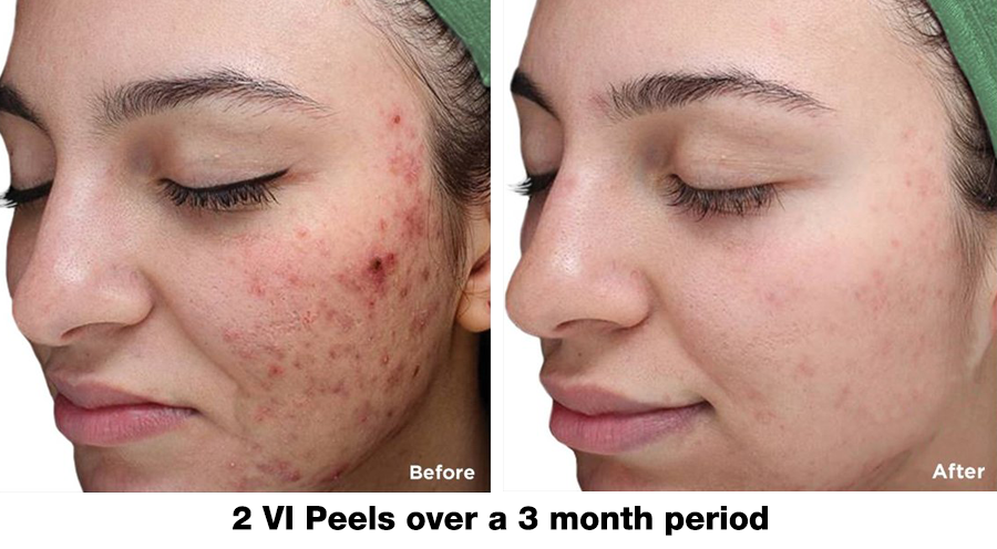 ba-active-acne-vipeel36