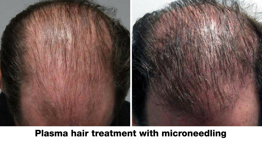 plasma-hair-treatment-w-microneedling