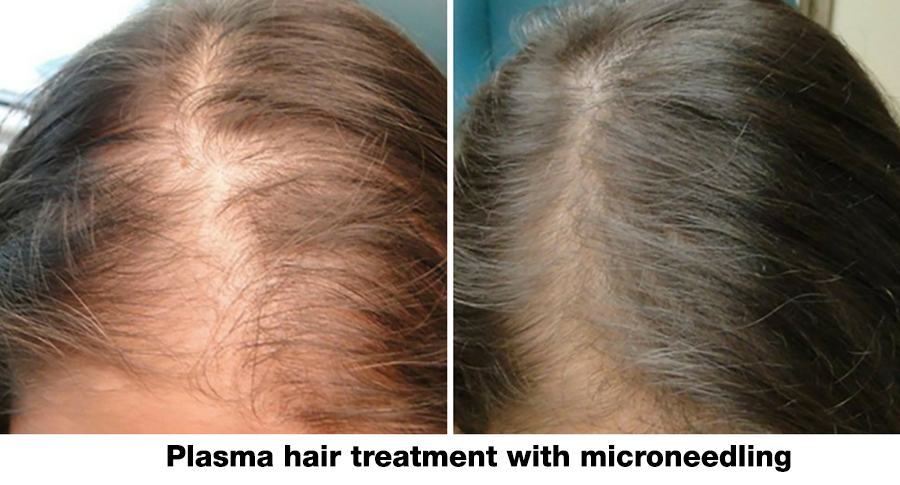 plasma-hair-treatment-w-microneedling.2