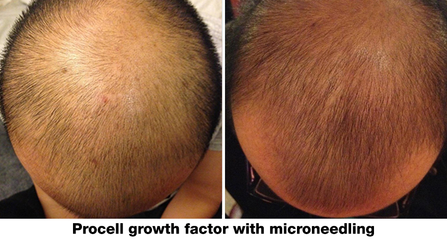 procell-growth-factor-w-microneedling