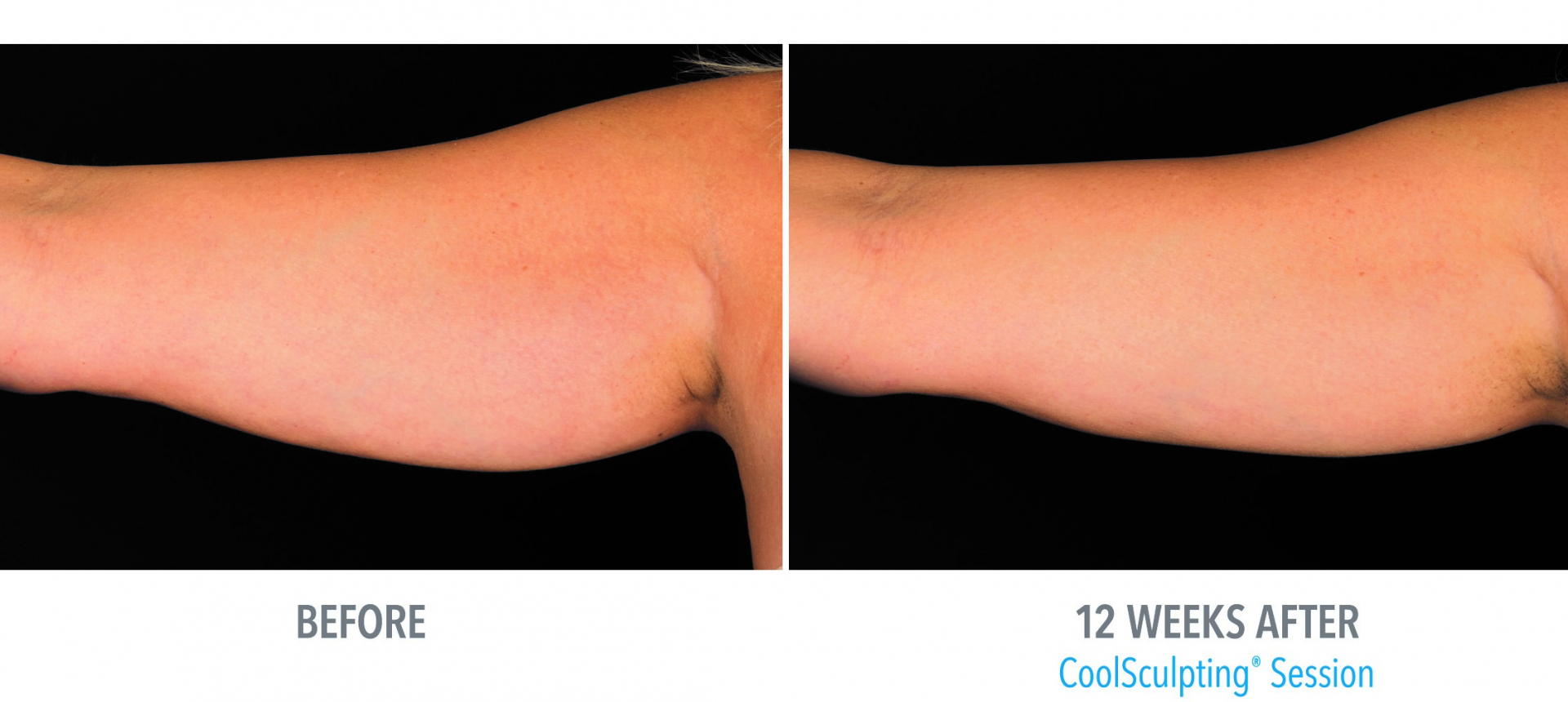 An Alternate to Liposuction - CoolSculpting!