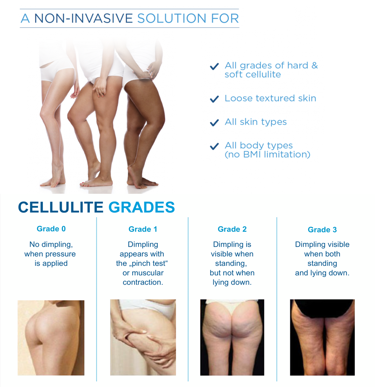 cellulite-grades-all-grades-in-1-for-webpage