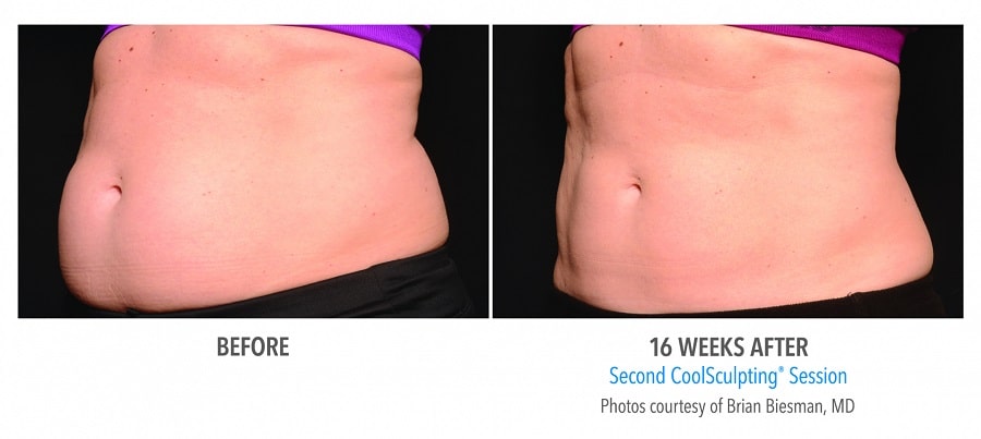 Real Results of Coolsculpting (Before/After Photos) - NOVA Plastic