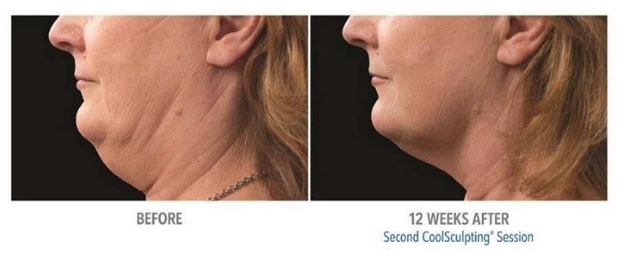 nuimage-coolsculpting-before-and-after-1-oypalbzylgpp7mpr30n8tbfysk5ucwvqs0uht8ruzc