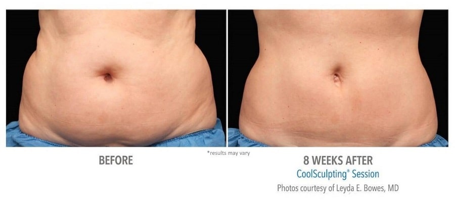 nuimage-coolsculpting-before-and-after-3-oypalbzylgpp7mpr30n8tbfysk5ucwvqs0uht8ruzc