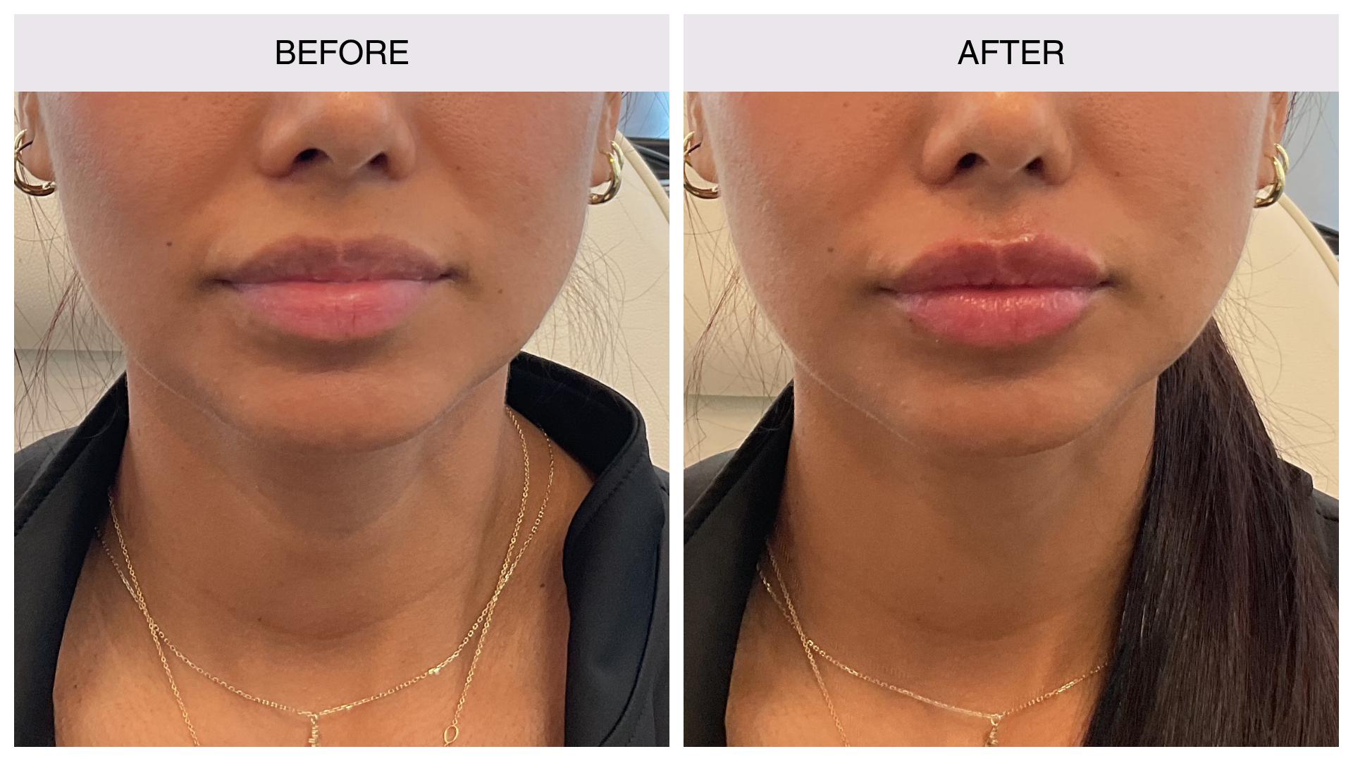 lip-filler-1 lip-filler-1