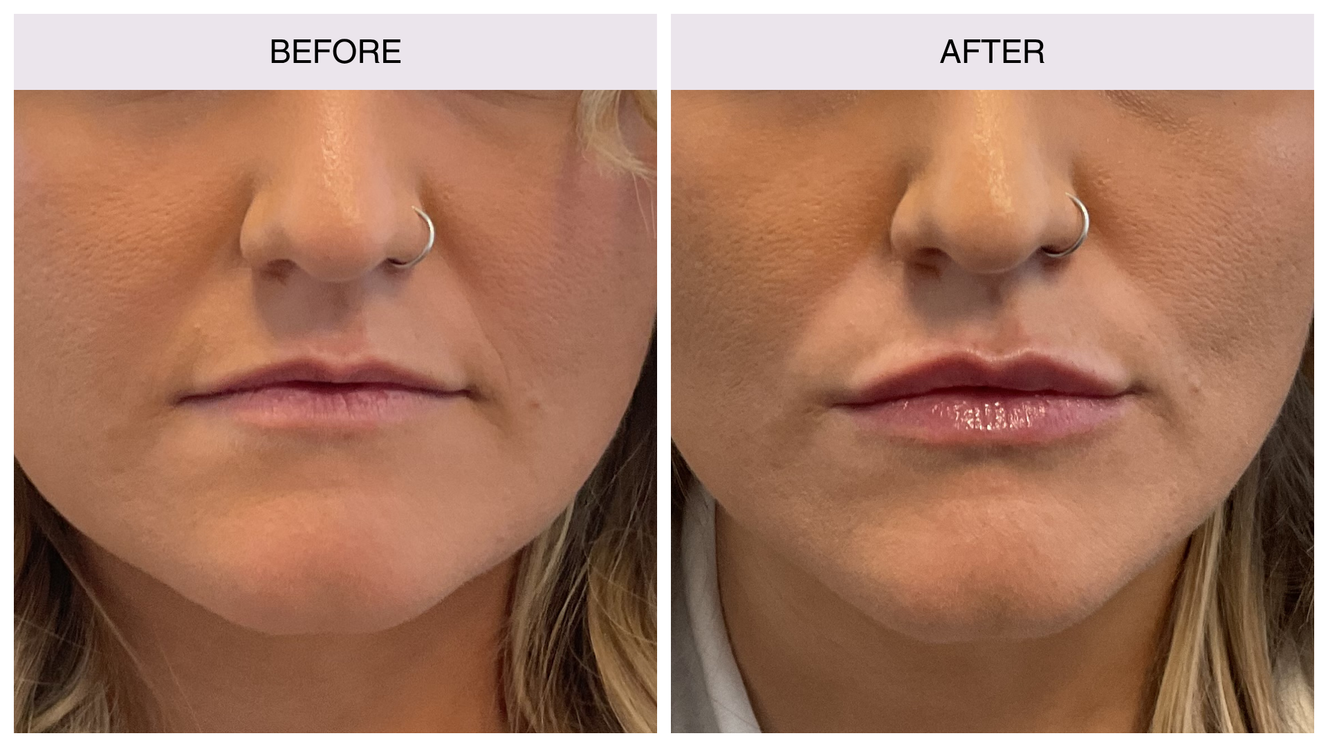 michelle-lip-filler michelle-lip-filler