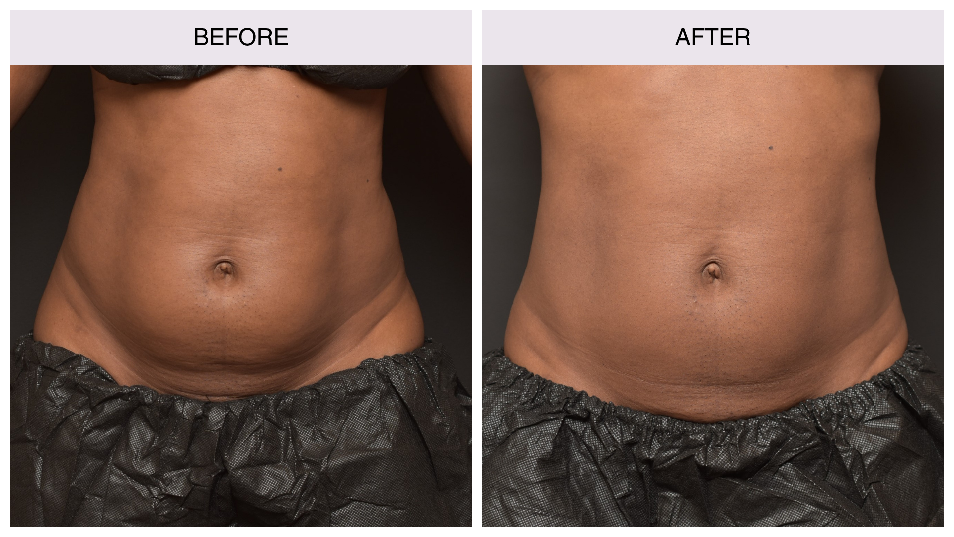 coolsculpting-woman-stomach-2 coolsculpting-woman-stomach-2