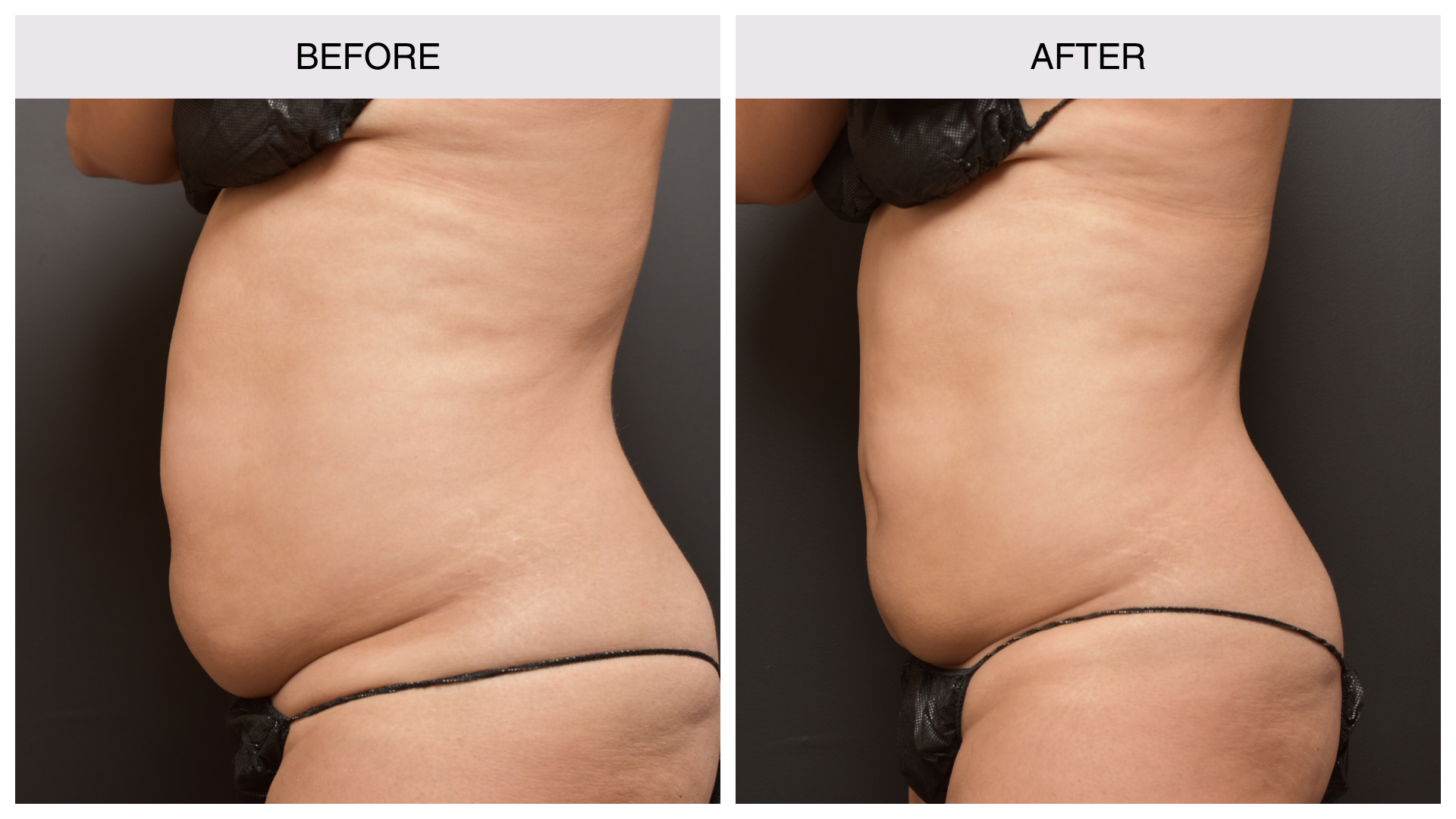 coolsculpting-woman-stomach coolsculpting-woman-stomach