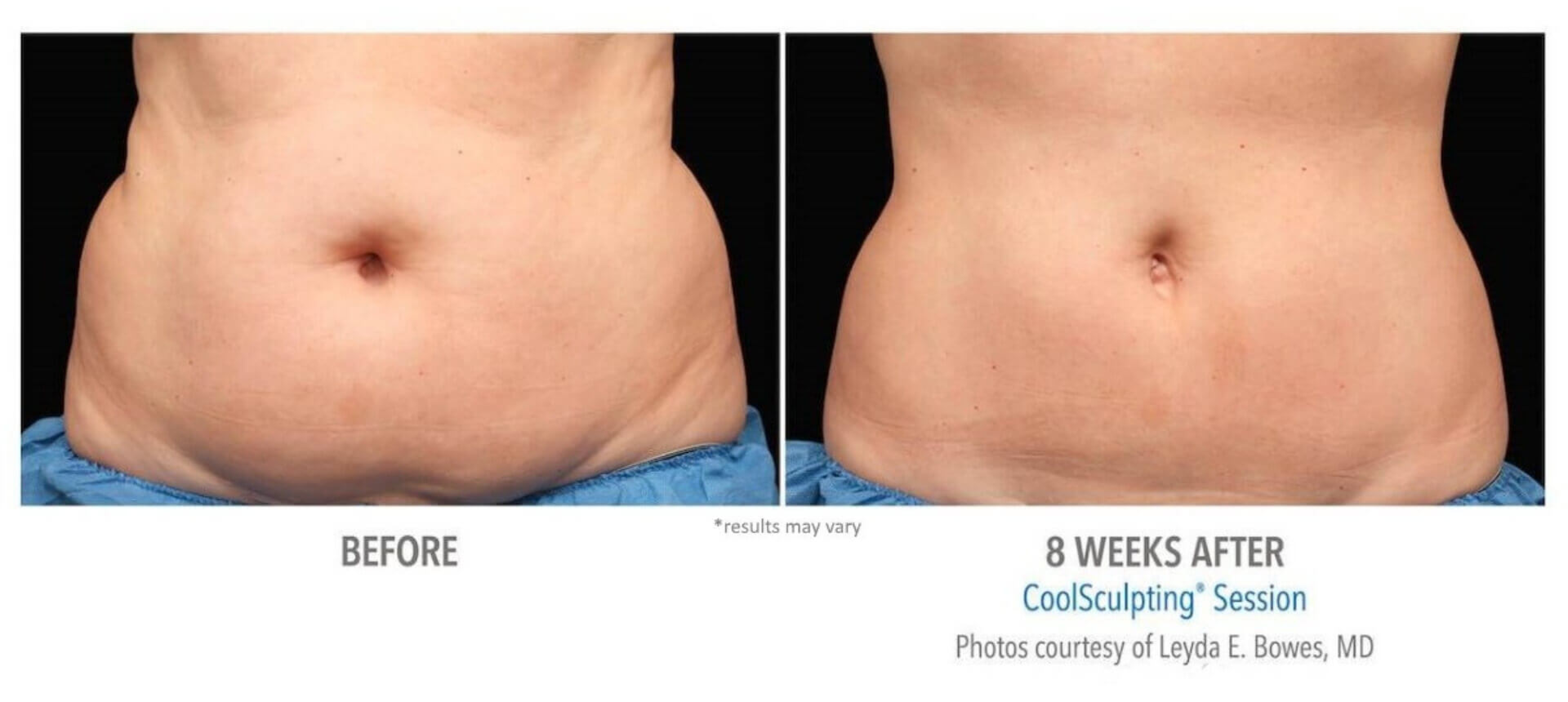 CoolSculpting Treatment NJ Freeze Your Fat Slate Medspa