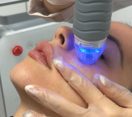 FRACTIONAL RF MICRONEEDLING – WHY VIVACE IS BEST - Slate Medspa